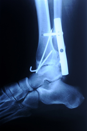 Lichfield, Ankle Surgery Rehabilitation, Physiotherapy, Sutton Coldfield