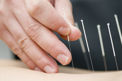 Acupuncture, Lichfield, Physiotherapy, Sutton Coldfield, Acupuncture