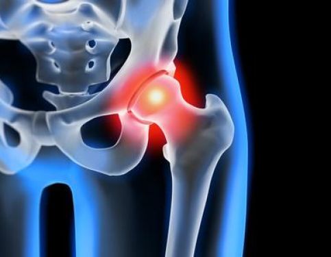 Physiotherapy at Home in Sutton Coldfield After A Hip Replacement