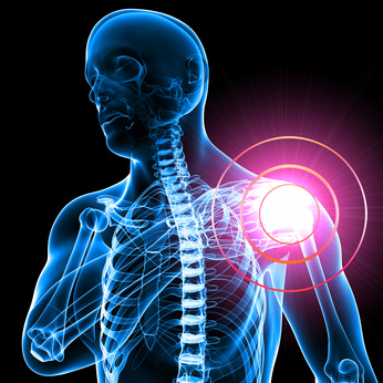 shoulder impingement